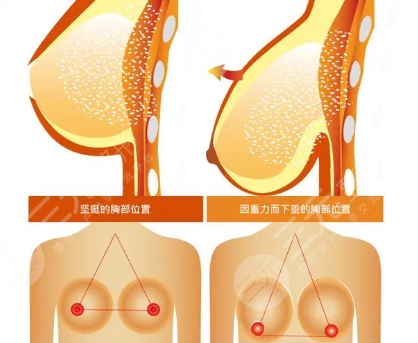 内窥镜隆胸和普通隆胸有什么区别？价格有差异！附术后护理~