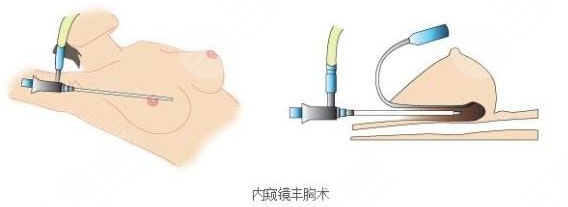 内窥镜隆胸和普通隆胸术后要如何进行护理