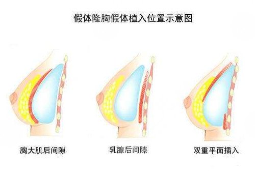 曼托隆胸术后如何护理?