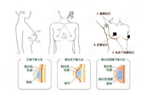 双平面隆胸