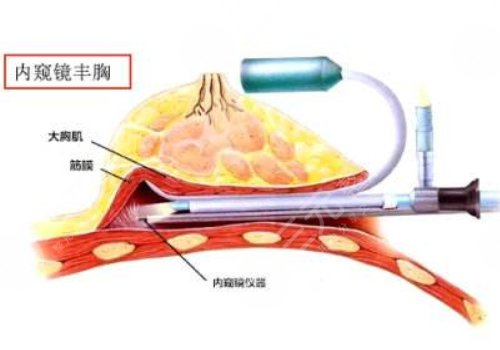 内窥镜隆胸术前注意事项：