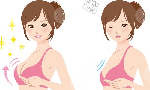 棉花糖隆胸真的可以预防包膜挛缩吗?
