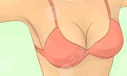 棉花糖隆胸真的不疼吗？可信吗？棉花糖隆胸案例术后：S曲线爆美！