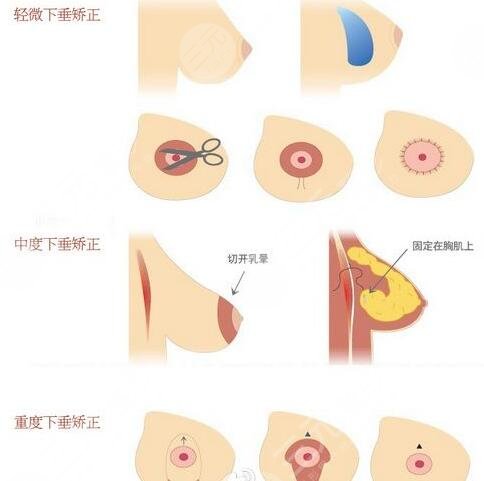 棉花糖隆胸真的不疼吗？