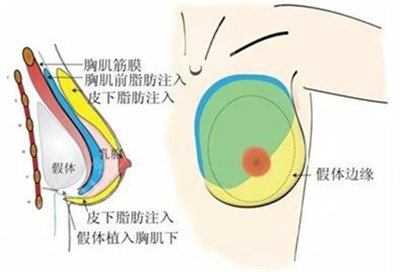 丰胸注意事项