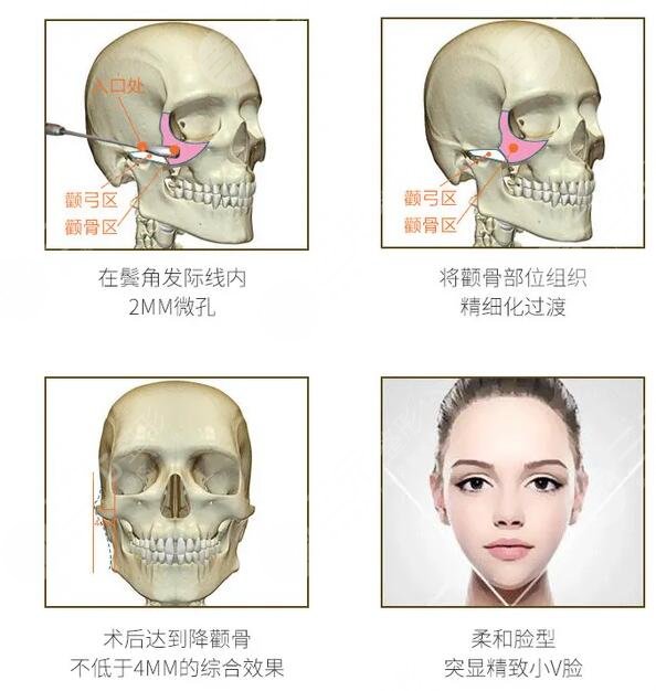 颧骨磨骨手术原理