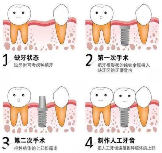 种植牙有哪些优点?