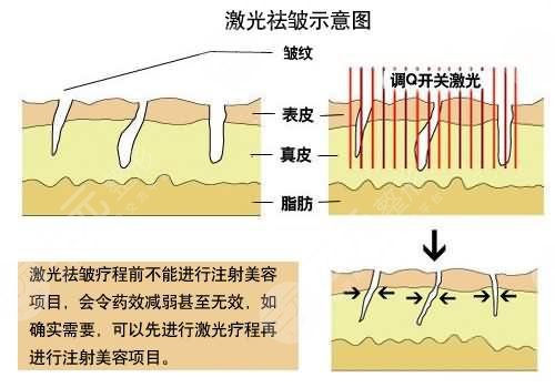 除皱抗衰