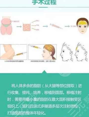 什么是自体脂肪隆胸?