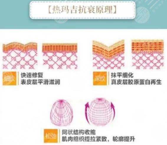 热玛吉除皱抗衰是什么原理