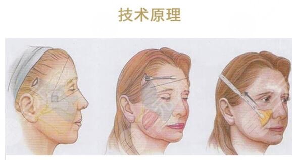 内窥镜面部提升手术果怎么样?维持多久?