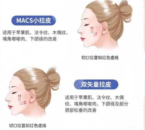 内窥镜面部提升手术术前要准备什么?