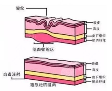 超声提拉抗衰的优势