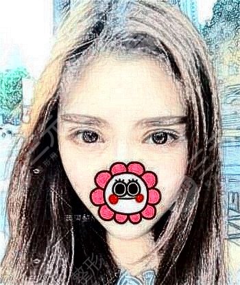 双眼皮失败修复案例