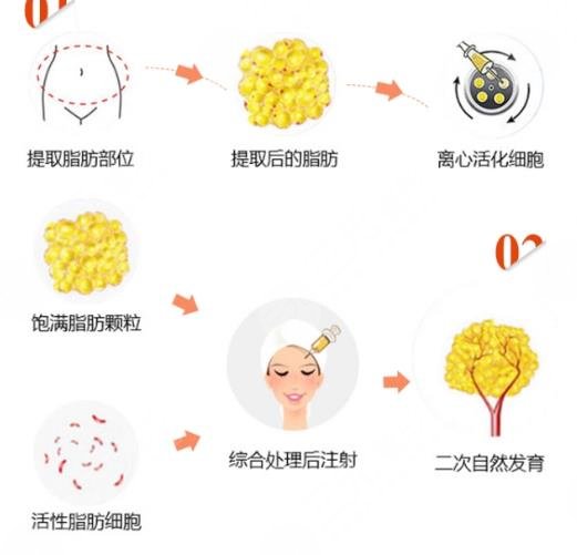 自体脂肪填充面颊具体操作的流程