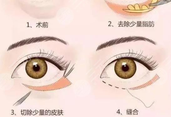 内切去眼袋是怎么做的