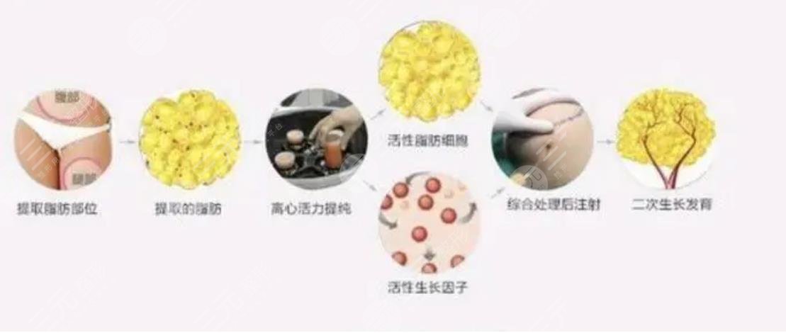 脂肪填充手术