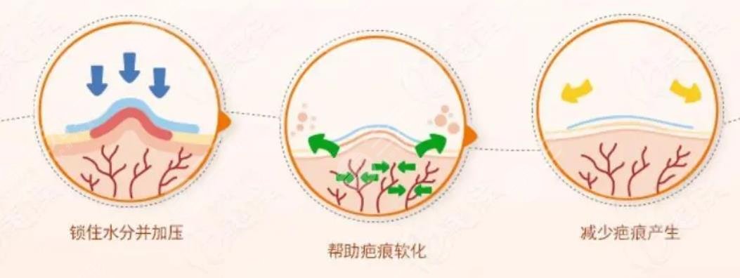 祛痘治疗有哪些方式?