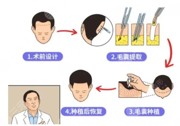 微针植发技术的优势和劣势