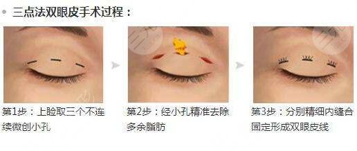 芭比双眼皮多项整形适合哪些人