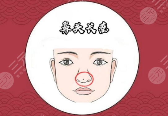 鼻子痣的位置与命运图
