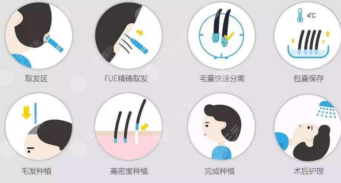 什么是FUT种植头发技术?