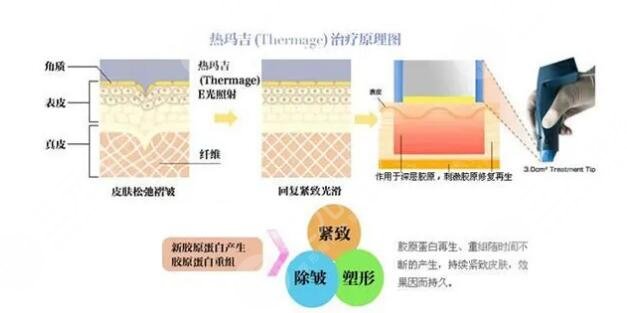 热玛吉多少发果比较好?