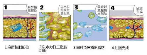 水动力吸脂一般需要多少钱?果怎么样?恢复期要3个月!附费用一览~