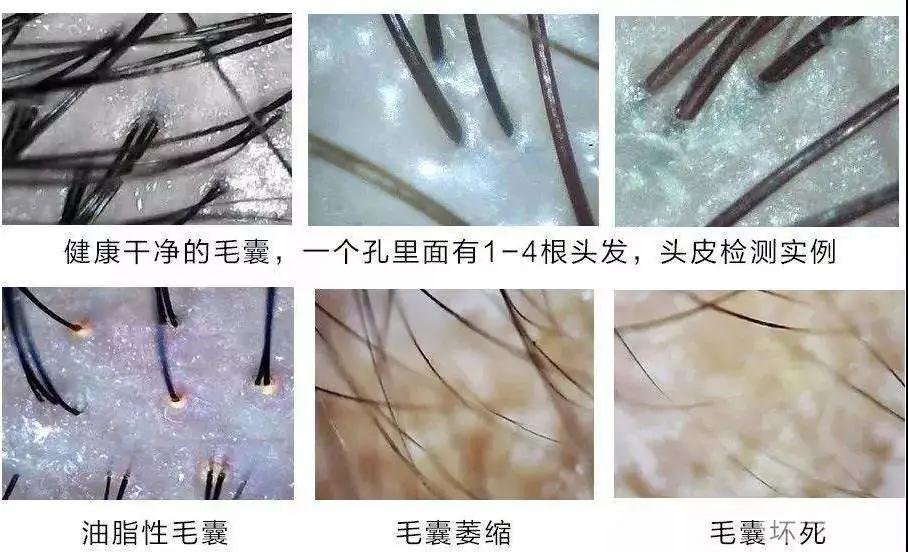头皮检测