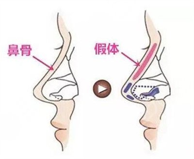 何栋良做鼻子案例图片