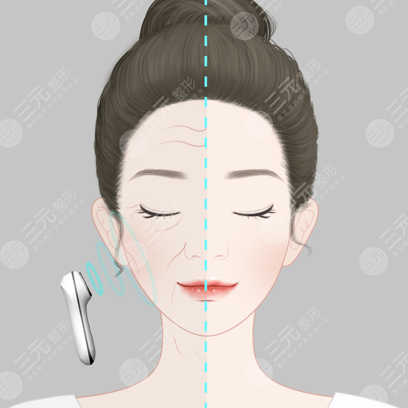 北京绽放轻医美玻尿酸填充案例
