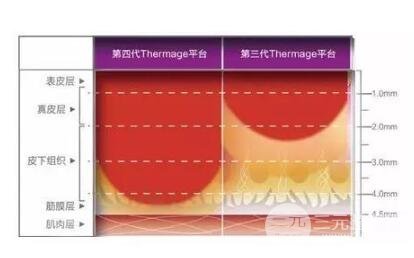 第新一代热玛吉治疗后的注意事项