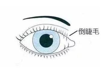 倒睫