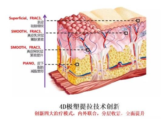4D火凤凰面部脂肪分解技术