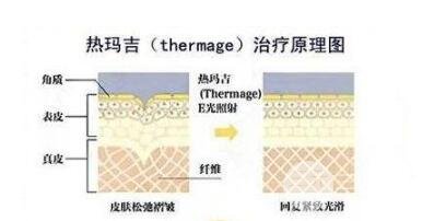 做热玛吉后要注意做好护理