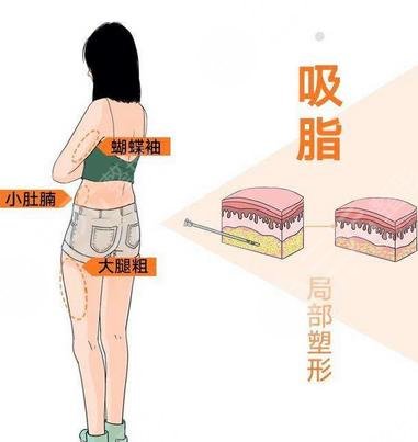 吸脂抽脂手术是怎么操作的?