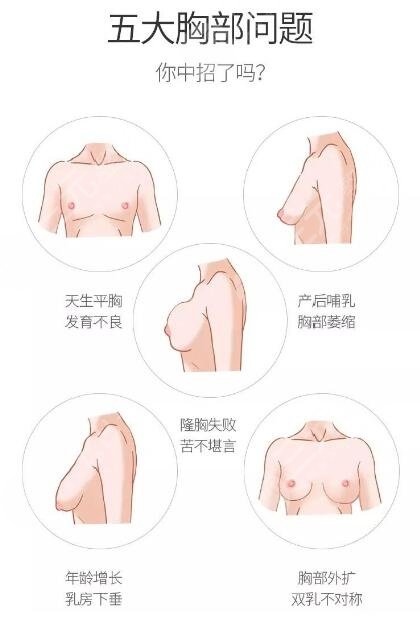 伊美尔健翔医院隆胸案例