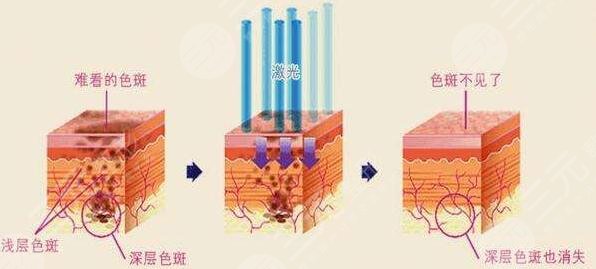 黄褐斑治疗