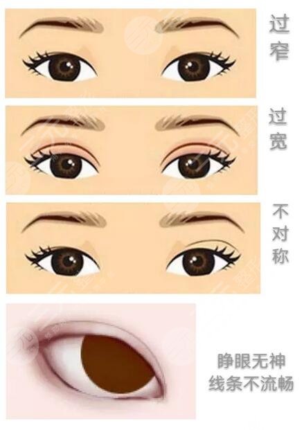 眼部整形案例