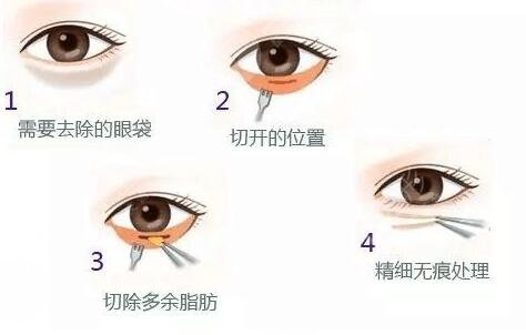 眼部整形术后