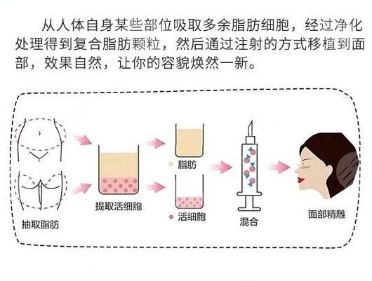 面部填充案例术后3周