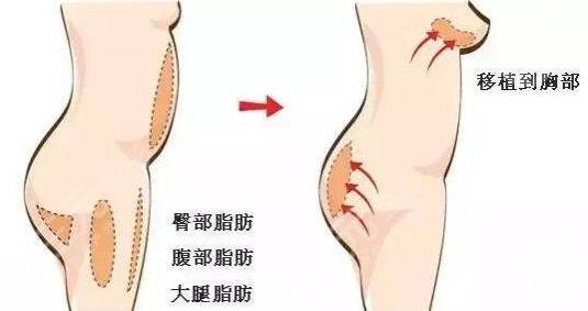 丰胸案例术后60天