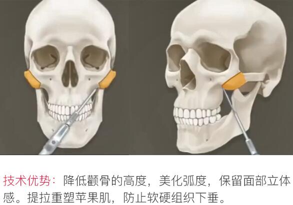 国内磨骨专家张笑天科普颧骨整形