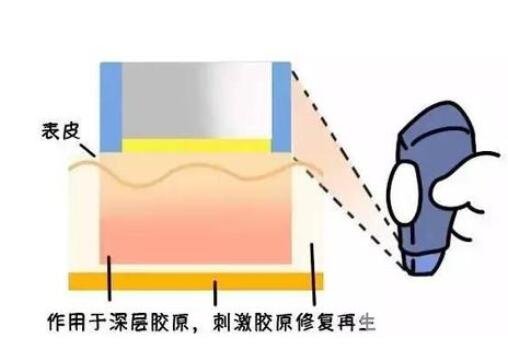什么是热玛吉?