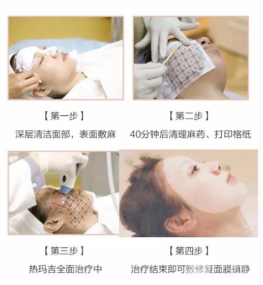 热玛吉的原理是什么?