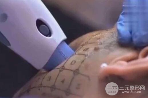 热玛吉的功是什么?