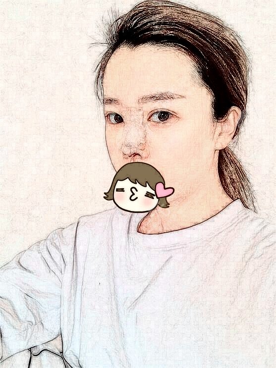 郑州隆鼻案例术中图