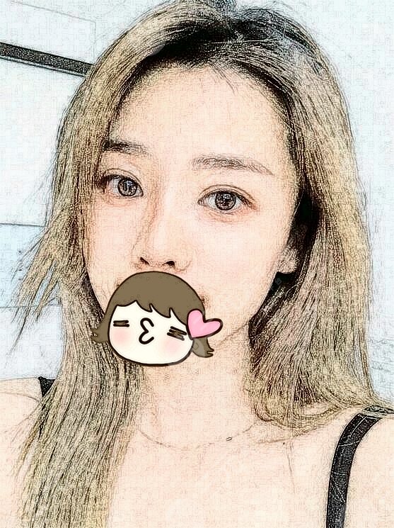 郑州隆鼻案例术后图