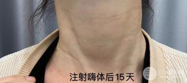 颜所嗨体注射15天