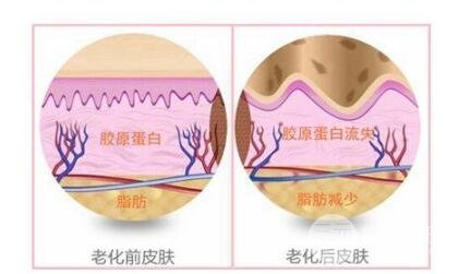 热玛吉探头可直通皱褶和松驰。